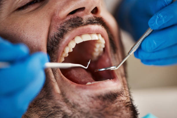 Best Dentist for Tooth Abscess  in Bridge City, TX