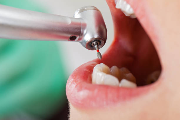 Best Teeth Whitening  in Bridge City, TX